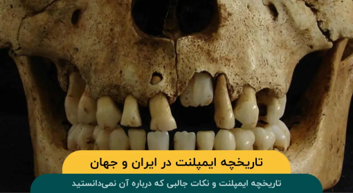 تاریخچه-ایمپلنت